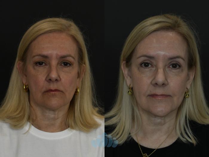 Before & After Eyelid Surgery Case 100 Front View in Charlotte, NC