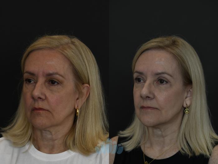 Before & After Eyelid Surgery Case 100 Left Oblique View in Charlotte, NC