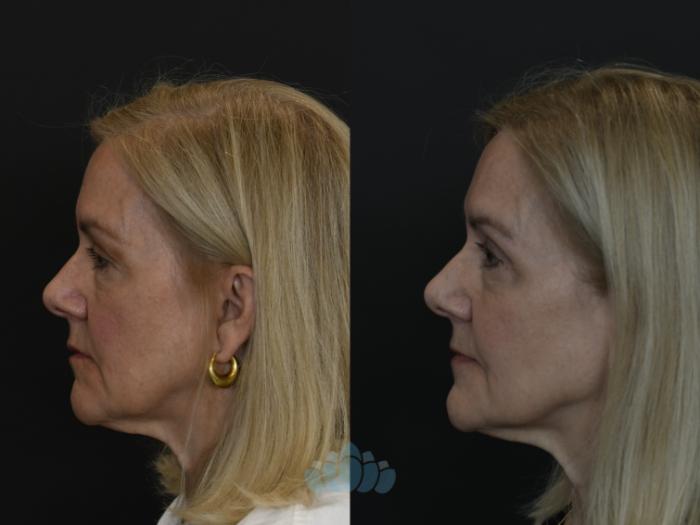 Before & After Eyelid Surgery Case 100 Left Side View in Charlotte, NC