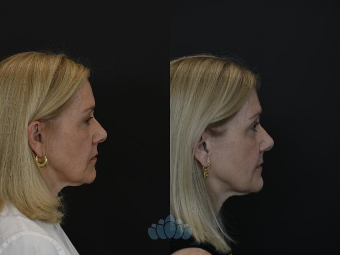 Before & After Eyelid Surgery Case 100 Right Side View in Charlotte, NC