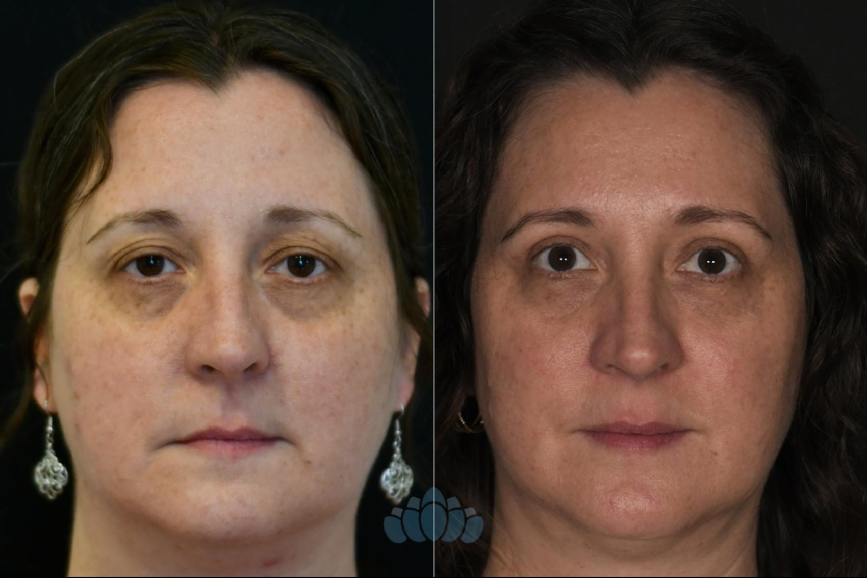 Before & After Eyelid Surgery Case 129 Front View in Charlotte, NC