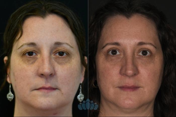 Before & After Eyelid Surgery Case 129 Front View in Charlotte, NC