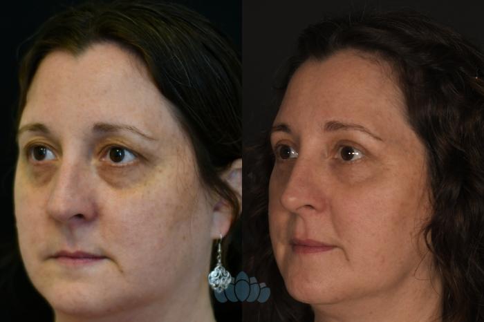Before & After Eyelid Surgery Case 129 Left Oblique View in Charlotte, NC