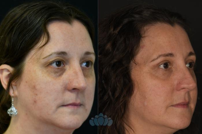 Before & After Eyelid Surgery Case 129 Right Oblique View in Charlotte, NC