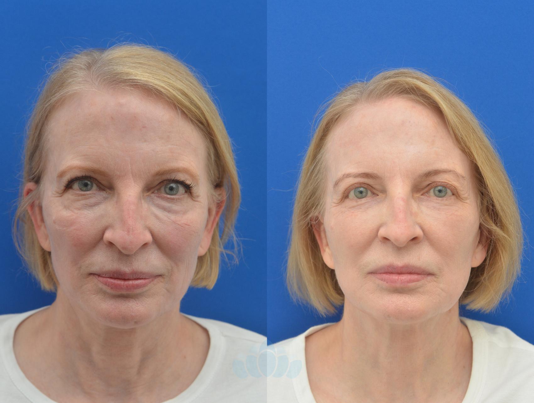 When Can I Start Wearing Makeup After Eyelid Surgery Saubhaya Makeup