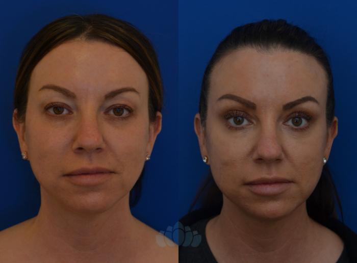 Before & After Eyelid Surgery Case 8 Front View in Charlotte, NC