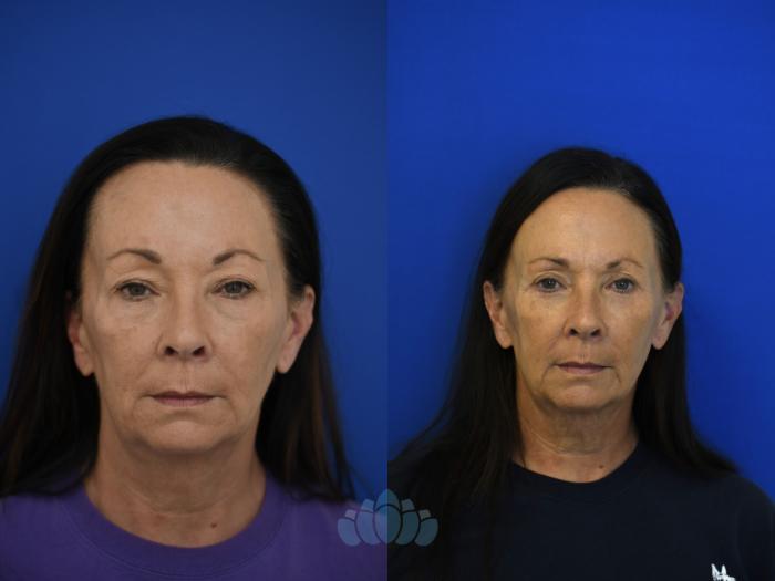 Before & After Eyelid Surgery Case 96 Front View in Charlotte, NC