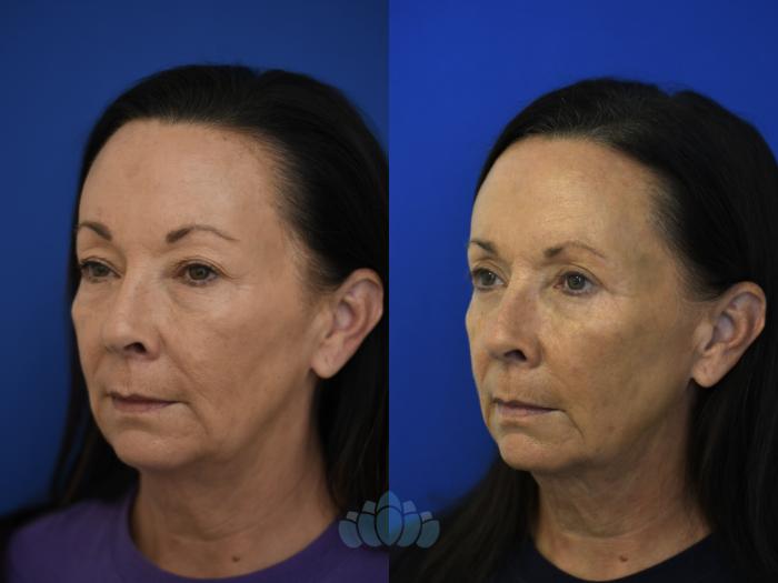 Before & After Eyelid Surgery Case 96 Left Oblique View in Charlotte, NC