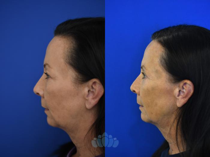 Before & After Eyelid Surgery Case 96 Left Side View in Charlotte, NC