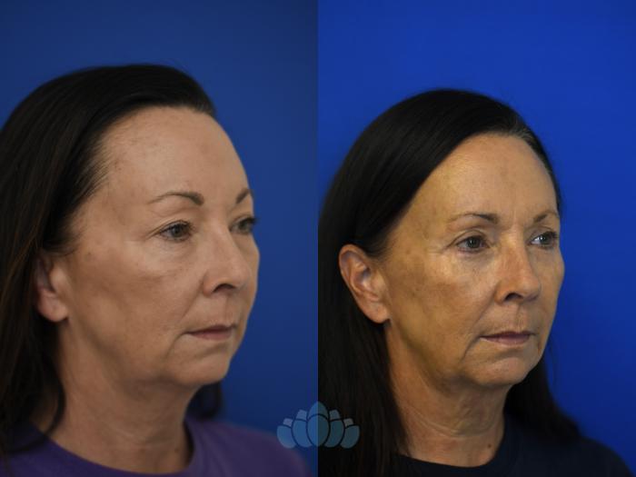 Before & After Eyelid Surgery Case 96 Right Oblique View in Charlotte, NC