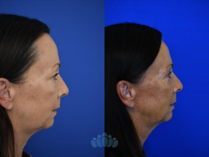 Before & After Eyelid Surgery Case 96 Right Side View in Charlotte, NC