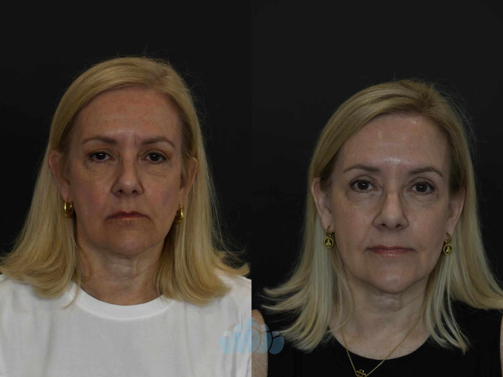 Before & After Eyelid Surgery Case 97 Front View in Charlotte, NC