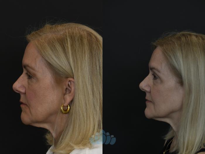 Before & After Eyelid Surgery Case 97 Left Side View in Charlotte, NC