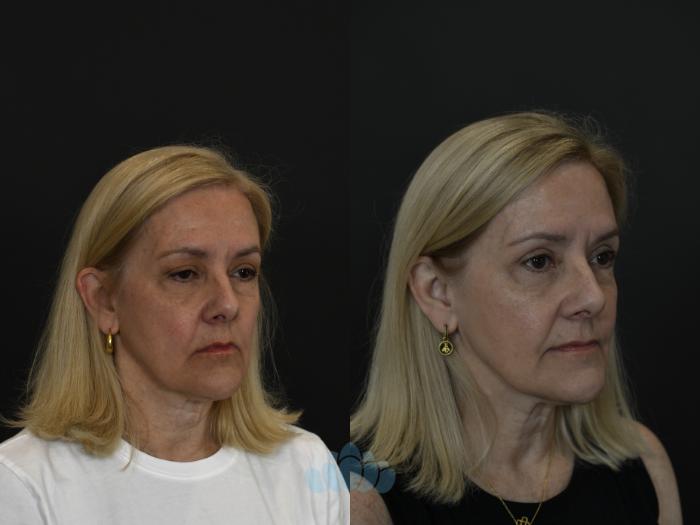 Before & After Eyelid Surgery Case 97 Right Oblique View in Charlotte, NC