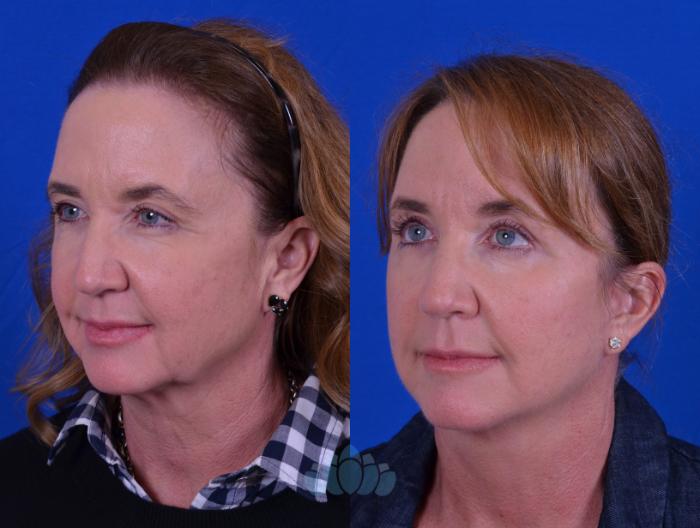 Before & After Facelift Case 102 Left Oblique View in Charlotte, NC