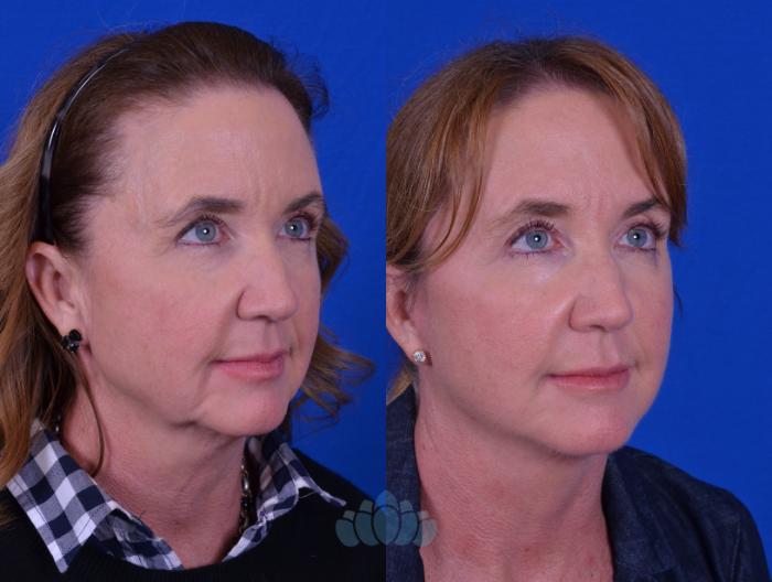 Before & After Facelift Case 102 Right Oblique View in Charlotte, NC