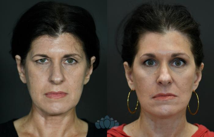 Before & After Facelift Case 104 Front View in Charlotte, NC