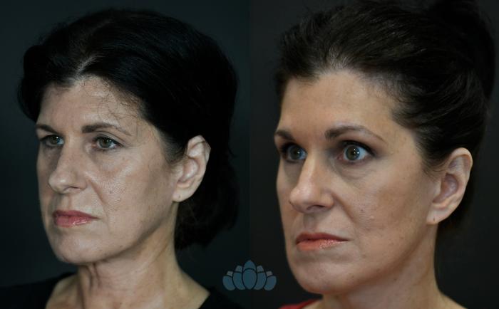 Before & After Facelift Case 104 Left Oblique View in Charlotte, NC