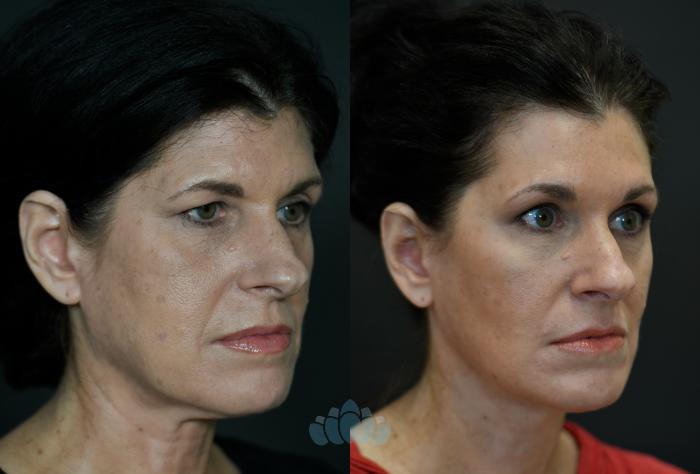 Before & After Facelift Case 104 Right Oblique View in Charlotte, NC