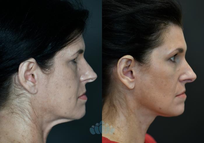 Before & After Facelift Case 104 Right Side View in Charlotte, NC