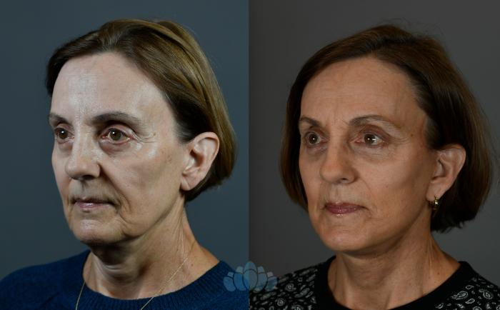 Before & After Facelift Case 107 Left Oblique View in Charlotte, NC