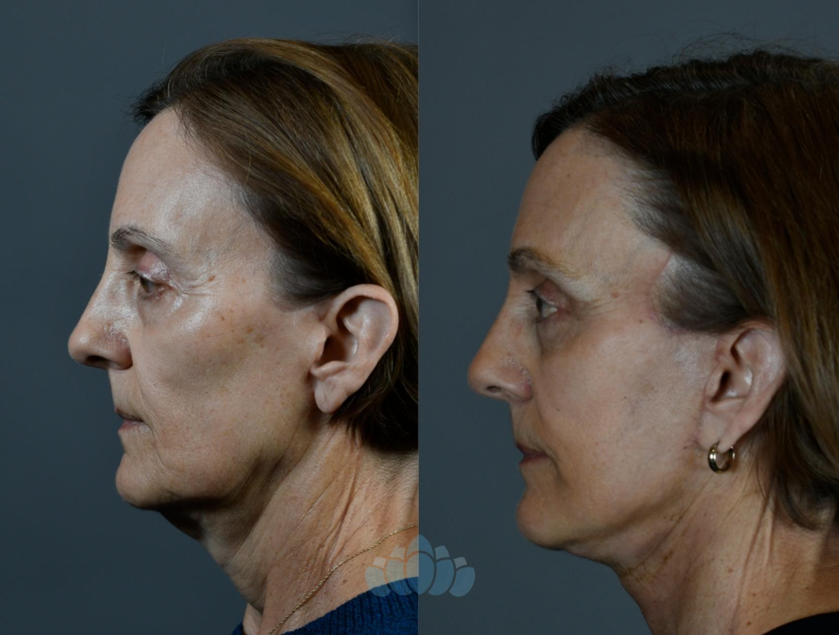 Before & After Facelift Case 107 Left Side View in Charlotte, NC