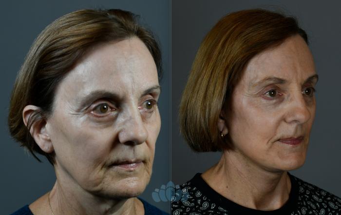 Before & After Facelift Case 107 Right Oblique View in Charlotte, NC