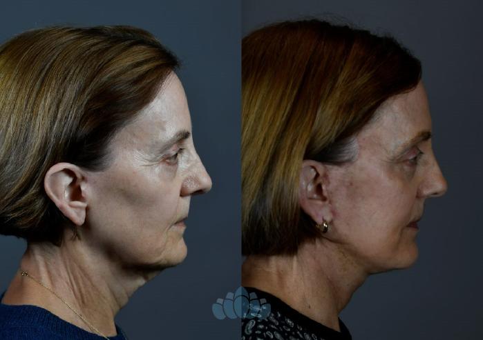 Before & After Facelift Case 107 Right Side View in Charlotte, NC