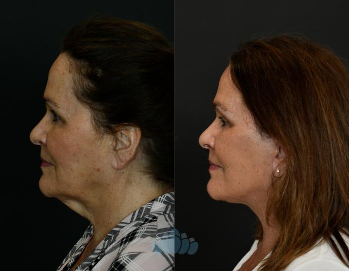 Before & After Neck Lift Case 108 Left Side View in Charlotte, NC