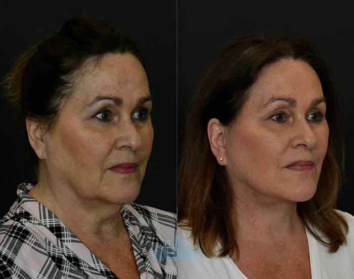 Before & After Facelift Case 108 Right Oblique View in Charlotte, NC