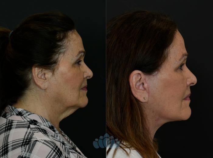 Before & After Facelift Case 108 Right Side View in Charlotte, NC