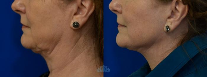 Before & After Facelift Case 112 Left Side View in Charlotte, NC