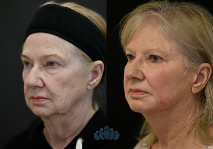 Before & After Facelift Case 114 Left Oblique View in Charlotte, NC