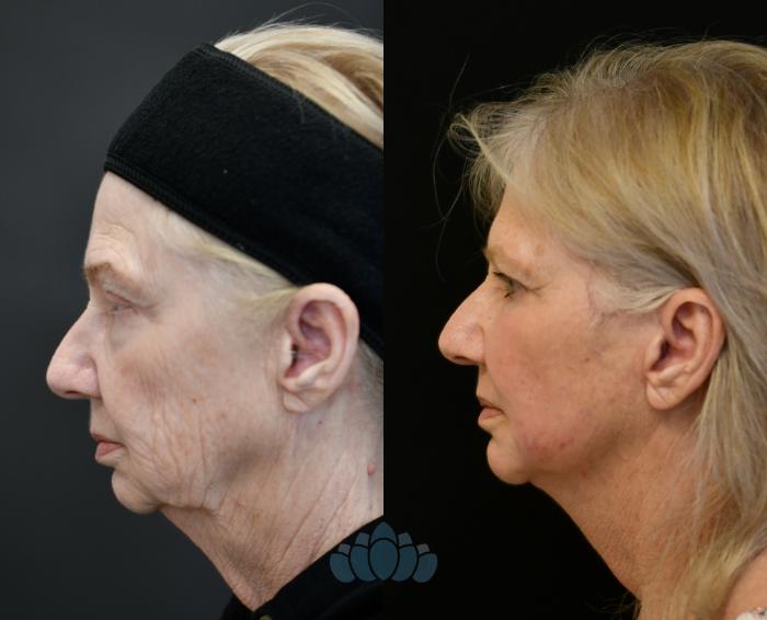 Before & After Facelift Case 114 Left Side View in Charlotte, NC