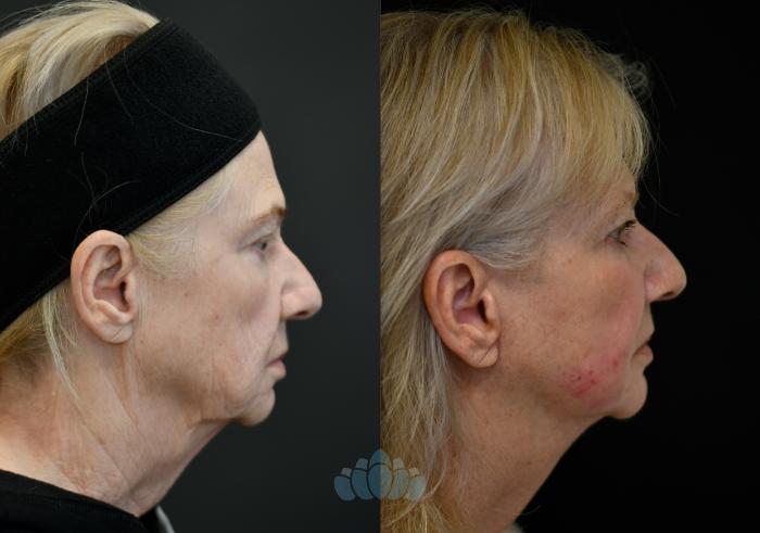 Before & After Facelift Case 114 Right Side View in Charlotte, NC