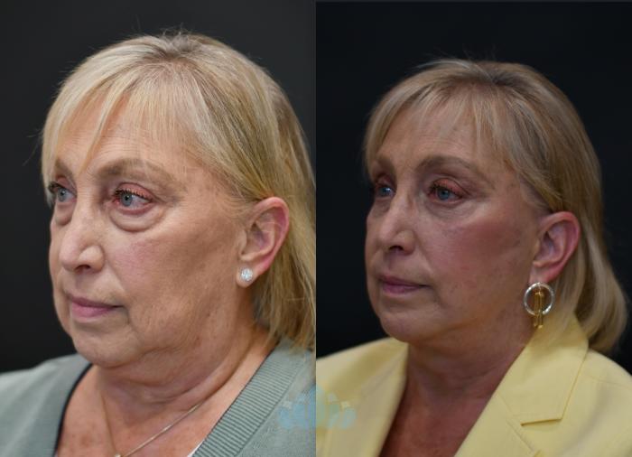 Before & After Facelift Case 116 Left Oblique View in Charlotte, NC
