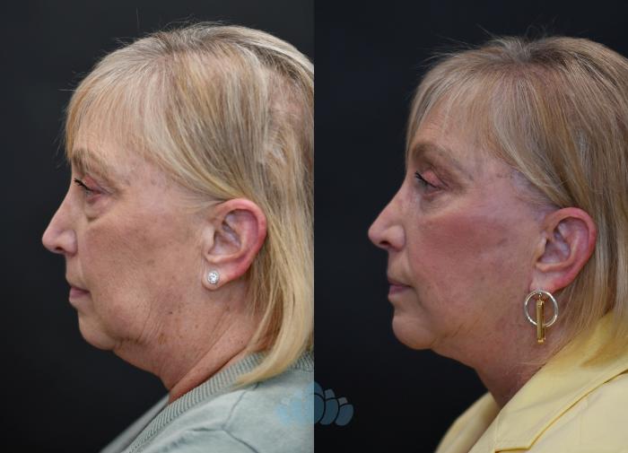 Before & After Facelift Case 116 Left Side View in Charlotte, NC