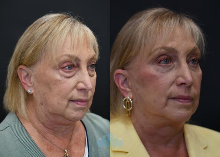 Before & After Facelift Case 116 Right Oblique View in Charlotte, NC