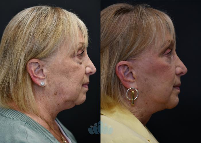 Before & After Facelift Case 116 Right Side View in Charlotte, NC