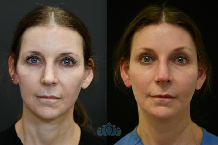Before & After Brow Lift Case 117 Front View in Charlotte, NC