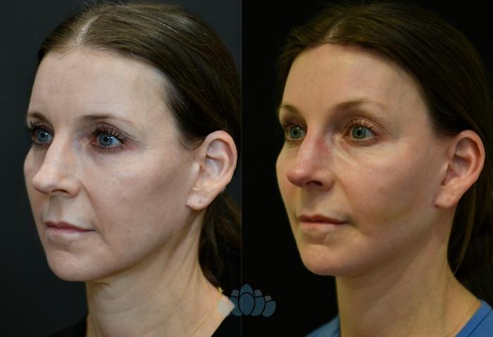 Before & After Brow Lift Case 117 Left Oblique View in Charlotte, NC