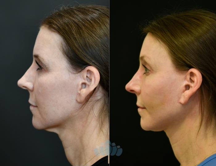 Before & After Brow Lift Case 117 Left Side View in Charlotte, NC