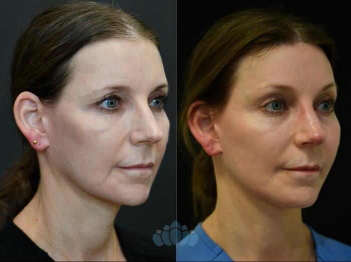 Before & After Brow Lift Case 117 Right Oblique View in Charlotte, NC