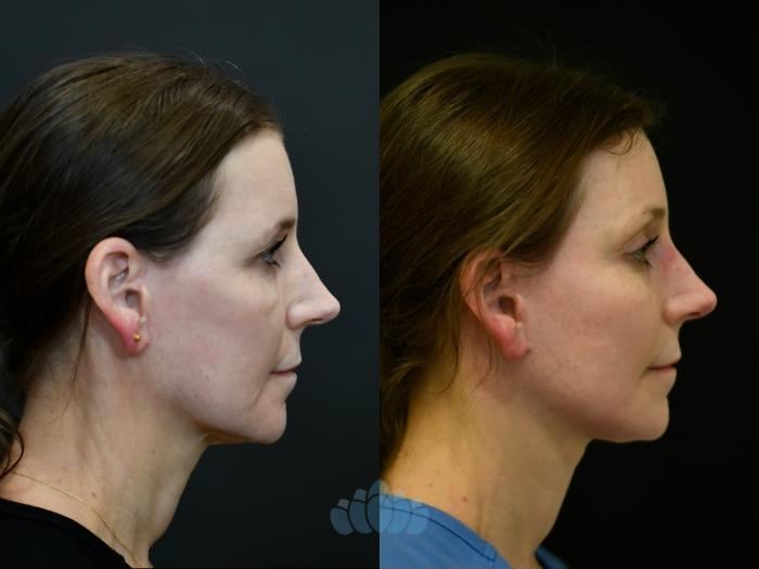 Before & After Brow Lift Case 117 Right Side View in Charlotte, NC