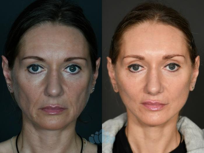 Before & After Facelift Case 119 Front View in Charlotte, NC