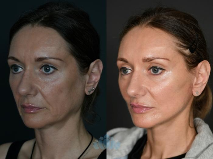 Before & After Facelift Case 119 Left Oblique View in Charlotte, NC