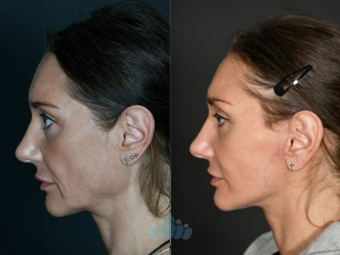 Before & After Facelift Case 119 Left Side View in Charlotte, NC