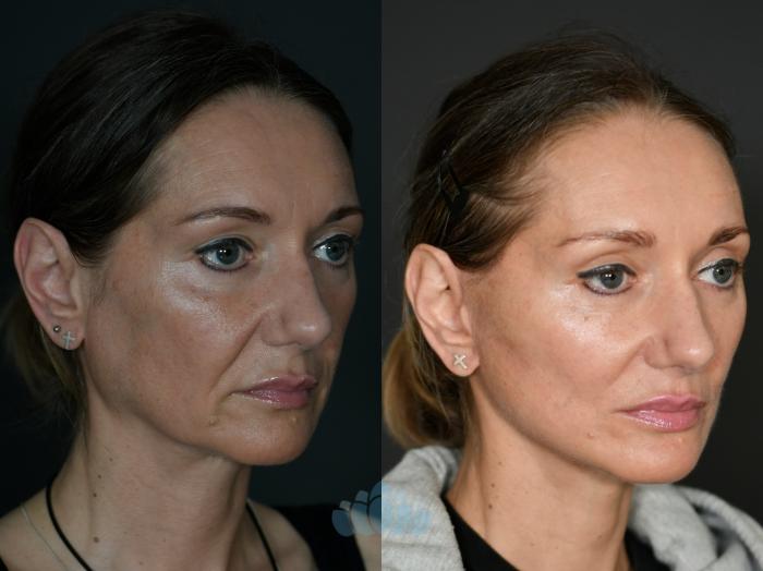 Before & After Facelift Case 119 Right Oblique View in Charlotte, NC