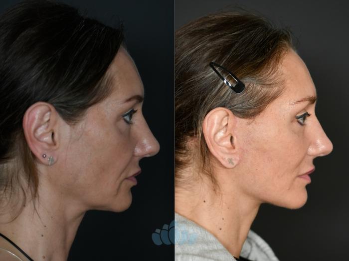 Before & After Facelift Case 119 Right Side View in Charlotte, NC