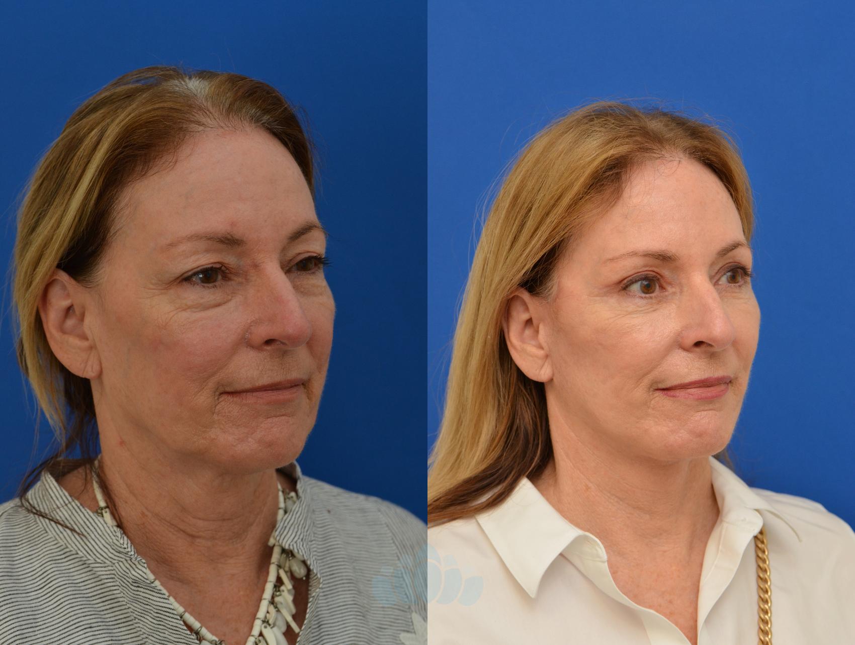 Before & After Facelift Case 12 Right Oblique View in Charlotte, NC